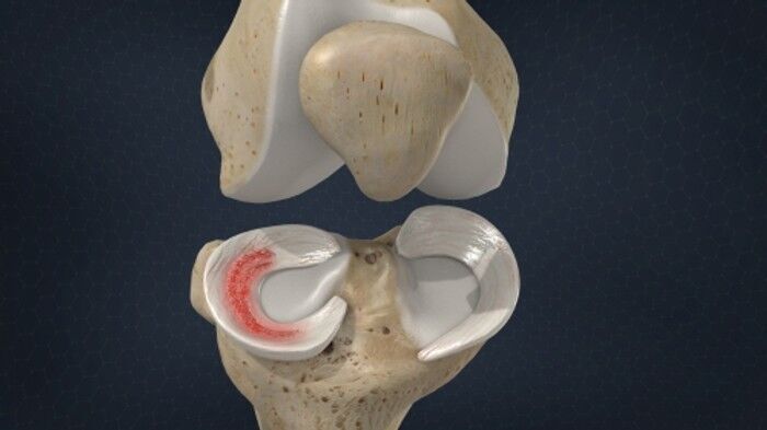 Meniscus