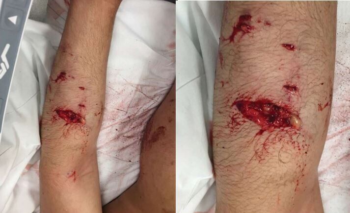 Adrian Martinez bite wound