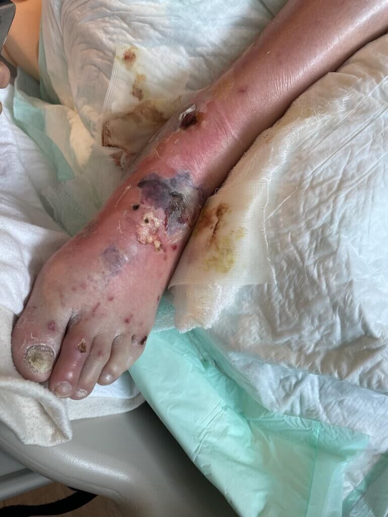 Wound that led to fatal sepsis
